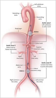 Traumatic Cardiac Arrest: Scoping Review of Utilization of Resuscitative Endovascular Balloon Occlusion of the Aorta